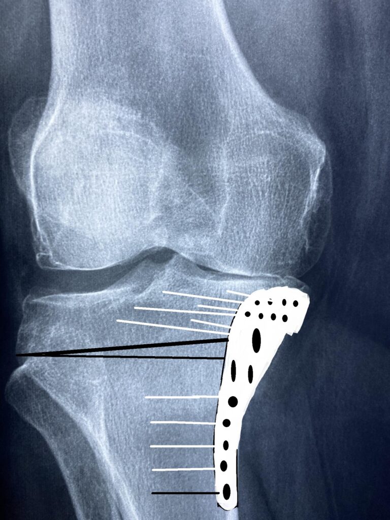 High Tibial Osteotomy - Orthopedics Notes